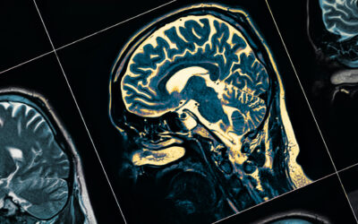 Stem Cell Therapy for Traumatic Brain Injury